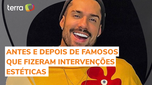 Bil Araújo reveals the appearance before facial harmonization