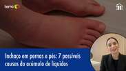 Inchaço em pernas e pés: 7 possíveis causas do acúmulo de líquidos