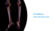 Traveler's thrombosis: how to prevent the problem caused by long journeys