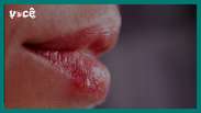 How do you get herpes?  Jairo Bouer explains how the virus manifests itself