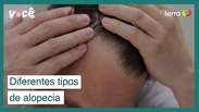 Por que meu cabelo cai? Conheça os diferentes tipos de alopecia