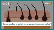 Disfunções hormonais causam crescimento descontrolado de pelos: como resolver
