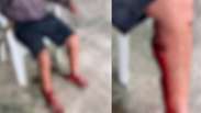 Homem tem m&uacute;ltiplos ferimentos nas pernas ap&oacute;s ser atacado por cachorros no litoral de SP