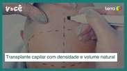 Transplante capilar com densidade e volume natural: conhe&ccedil;a o m&eacute;todo DVN