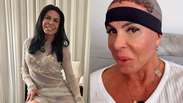 Gretchen atualiza recupera&ccedil;&atilde;o ap&oacute;s transplante capilar: &lsquo;Olha como estou bem&rsquo;