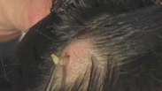 Americana filma larva em seu couro cabeludo