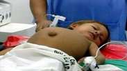 Peru: médicos encontram feto de 25 cm na barriga de menino