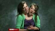 Vídeo mostra rotina de gêmeas siamesas nos EUA