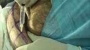 Médico faz autocirurgia plástica; veja procedimento