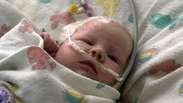 Supercola salva bebê com aneurisma cerebral