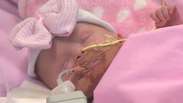 Bebê nascida com coração fora do corpo sobrevive a cirurgia 