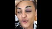 Pabllo Vittar fica com olho roxo após ensaio de clipe: 'Dei joelhada na cara'