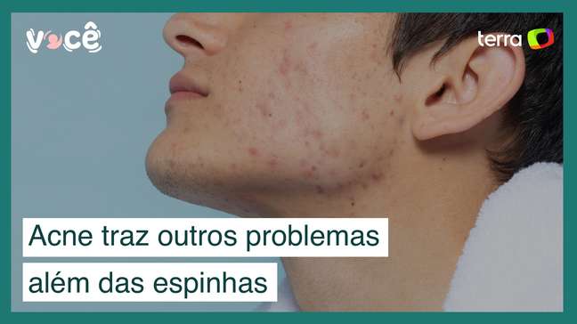 Não são só espinhas: entenda outros problemas trazidos pela acne