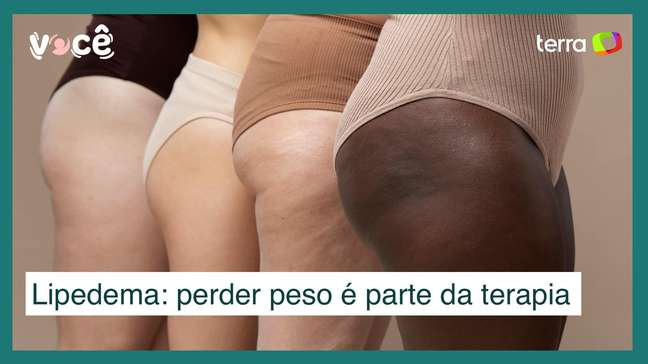 Lipedema: perda de peso é a terapia, mas não diminui inflamação das coxas