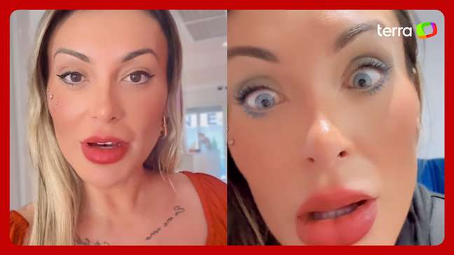 Andressa Urach relata ‘dor’ e ‘medo de ficar cega’ após cirurgia para mudar cor dos olhos