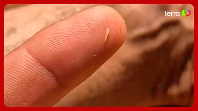 Dente de cobra fica preso na pele de influenciador de MS após mordida rara