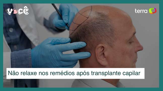 Fazer transplante capilar não significa largar os medicamentos para calvície