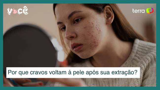 Cravos são invencíveis? Por que retornam à pele após extração?