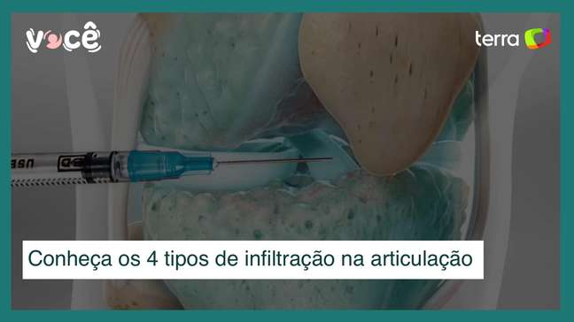 Joint infiltration: understanding the 4 types and uses to reduce pain Joint infiltration: understanding the 4 types and uses to reduce pain