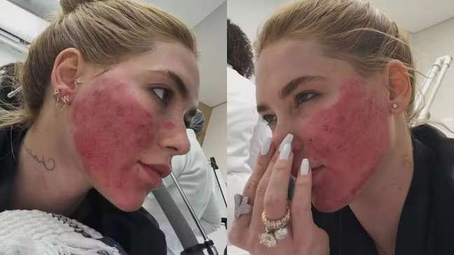 Virginia tranquiliza fãs após aparecer com rosto 'em carne viva' por procedimento estético