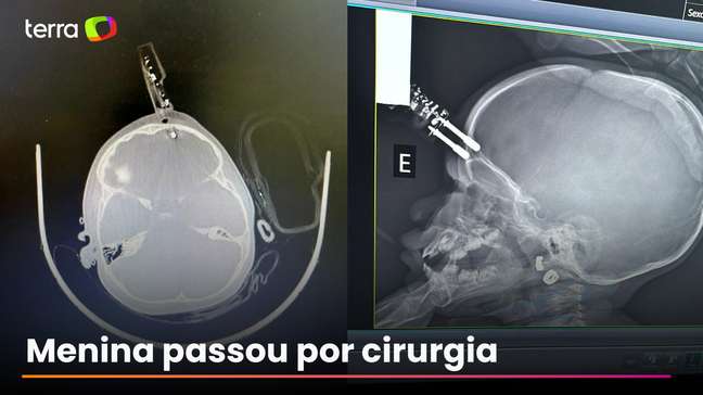 Criança de 1 ano fica com carregador cravado na testa após cair da cama em MG