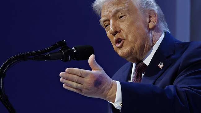 Hematoma na mão de Trump volta a chamar atenção em Davos