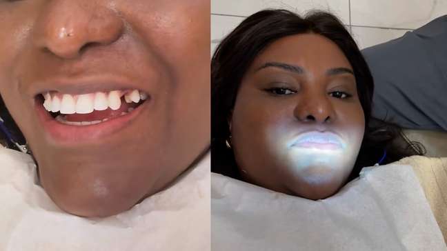 Ex-Rouge quebra dente comendo bacalhau e corre para consertar: ‘Usar bastante essa boca no carnaval'