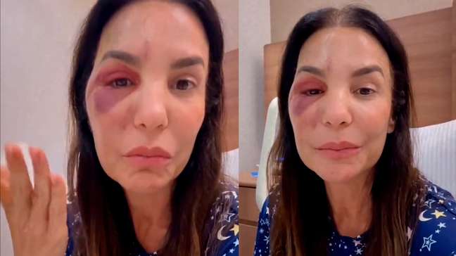 ‘Houve uma ruptura de osso’, diz Ivete Sangalo sobre cirurgia que fez no rosto após queda no banheiro