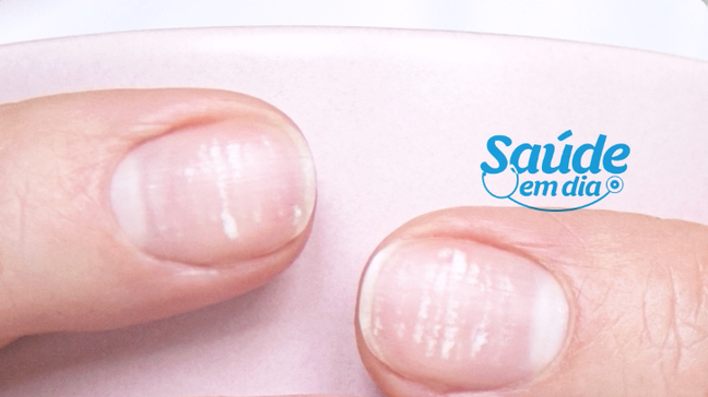 O que o formato das suas unhas revela sobre a falta de vitaminas