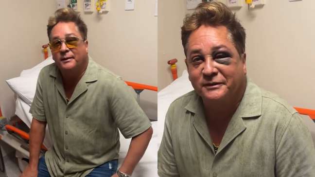 Leonardo sofre acidente e aparece com olho roxo nas redes sociais: 'Não está muito bonito'