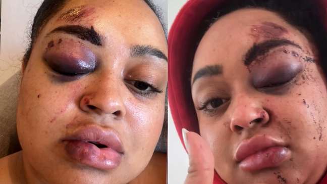 Ex-BBB Rízia Cerqueira detalha acidente com moto elétrica e mostra ferimentos: 'Fiquei arrebentada'