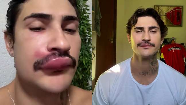 Influenciador ‘Ken de CG’ é internado após espremer espinha no rosto e faz alerta: ‘Meu rosto ficou assim’