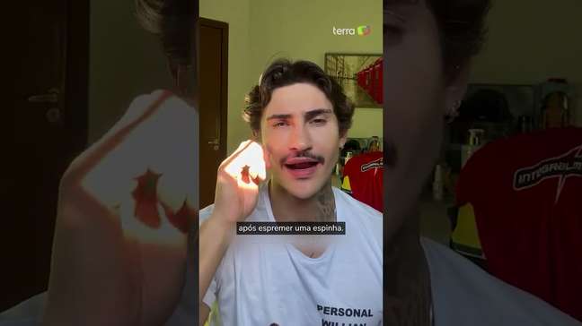 Espremer espinhas pode matar? Entenda o que é a 'zona da morte' do rosto #shorts
