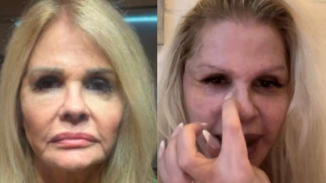 Monique Evans mostra resultado uma semana após rejuvenescimento facial: 'Novo rosto'