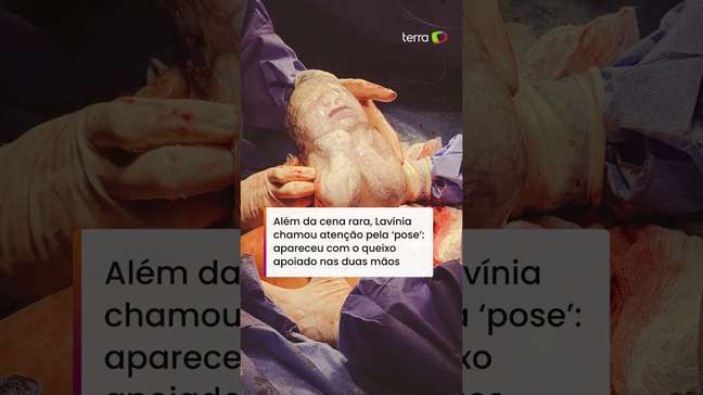 Bebê nasce empelicada e chama atenção ao aparecer fazendo 'pose' dentro da bolsa #shorts